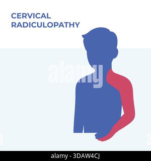 Vektor-Illustration, die Schmerzverteilungsbereiche zeigt, die mit zervikaler Radikulopathie assoziiert sind, wobei Nacken-, Schulter- und Armregionen hervorgehoben werden. Vereinfacht Stockfoto