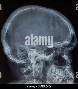 Röntgenbild des menschlichen Schädels in der Seitenansicht mit kleiner Schädeleinbuchtung durch stumpfe Krafteinbußen Stockfoto