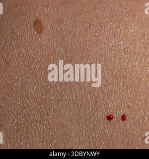 Hochauflösendes Makro der menschlichen Haut mit Maulwurf und roten Läsionen, ideal für Dermatologie Ausbildung, medizinische Inhalte, Gesundheitsbewusstsein Kampagnen, realistisch Stockfoto