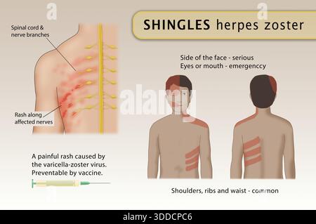 Eine medizinische Illustration der häufigsten Körperbereiche für die Gürtelrose (Herpes zoster) Ausschlag erscheinen Stockfoto