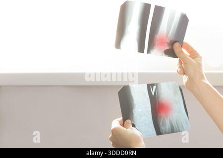 Ein Arzt hält und untersucht Röntgenstrahlen eines gebrochenen Arms auf einem Lichtschirm. Medizinische Diagnostik von Verletzungen, Knochenmonitoring und Behandlung Stockfoto