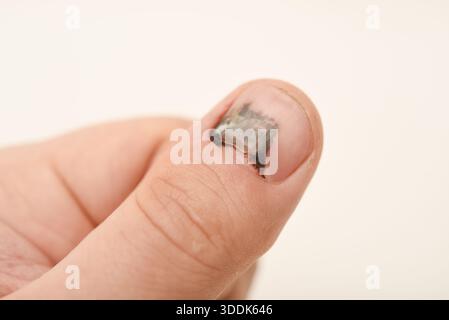 Ein beschädigter Finger an der Hand. Ein beschädigter Nagel und Blut unter dem Nagel. Die Regeneration des Fingernagels. Stockfoto