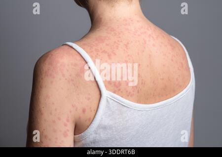 Eine Frau mit einem roten, fleckigen Hautausschlag, verursacht durch Masern. Stockfoto