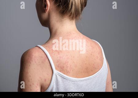 Eine Frau mit einem roten, fleckigen Hautausschlag, verursacht durch Masern. Stockfoto