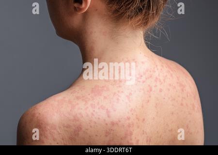 Eine Frau mit einem roten, fleckigen Hautausschlag, verursacht durch Masern. Stockfoto