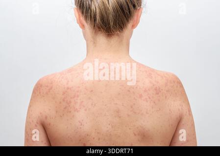 Eine Frau mit einem roten, fleckigen Hautausschlag, verursacht durch Masern. Stockfoto