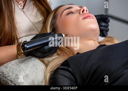 Entfernung des Muttermals vom Kinn des Klienten. Nahaufnahme. Konzept der Laserkosmetologie und Elektrokoagulation. Entfernung von Hautmolen. Melanombehandlung Stockfoto
