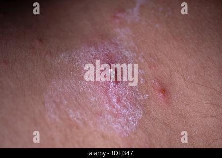 Nahaufnahme einer Hauterkrankung mit Rötung, Reizung und einer kleinen Läsion mit weißem Ausfluss am Arm einer Person Stockfoto