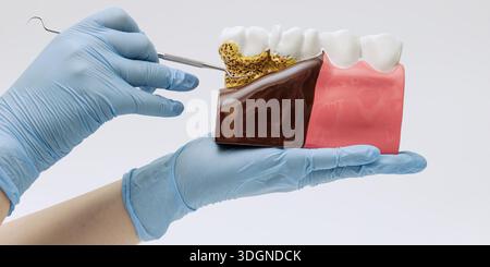 Handschuhe mit einem Querschnittmodell für Zahnfleisch und Zähne, die Plaquebildung und Zahnfleischerkrankungen zeigen, um Zahnerziehung und Mundhygiene zu fördern. Stockfoto