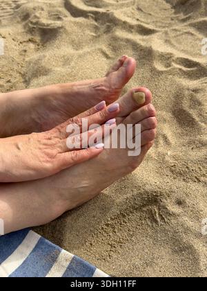 Nahaufnahme von weiblichen Füßen am Sandstrand mit beschädigtem Zehennagel. Konzept der Fußgesundheit, Nagelproblem, Hautpflege, medizinischer Zustand und persönliche Hygie Stockfoto