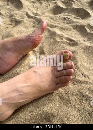 Nahaufnahme von weiblichen Füßen am Sandstrand mit beschädigtem Zehennagel. Konzept der Fußgesundheit, Nagelproblem, Hautpflege, medizinischer Zustand und persönliche Hygie Stockfoto