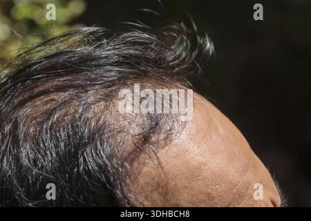 Männliche Stirn mit dünner werdendem schwarzem Haar und Kopfhautproblemen, die Alter und Haarausfall zeigen Stress und Unzufriedenheit über Glatzenkopf und zurückziehenden Haarlinien-Ski Stockfoto