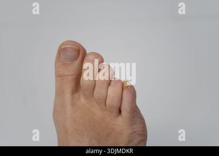 Podologie Fuß Nahaufnahme mit gelbem Zehennagel zeigt Nagelpilz und Fuß Gesundheit Problem Stockfoto