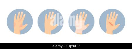 Verschiedene Handverletzungen. Psoriasis, Fraktur, Schnitt und gesunde Hand. Handhautprobleme. Stock Vektor