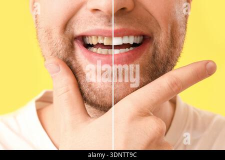 Lächelnder junger Mann vor und nach Zähnen, die auf gelbem Hintergrund aufhellt, Nahaufnahme Stockfoto