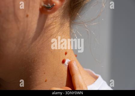 Nahaufnahme eines weiblichen Nackens mit sichtbaren Muttermalen, die die Bedeutung der Sonneneinstrahlung und regelmäßige Melanom-Kontrollen für die Gesundheit der Haut hervorheben Stockfoto