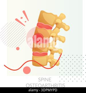 Wirbelsäulenosteoarthritis – Verschleiß und Tränen – Wirbelsäulengelenke – Stockbild als EPS 10-Datei Stock Vektor