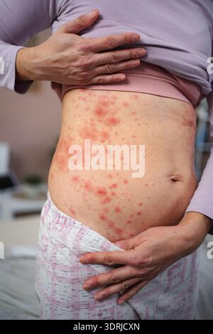 Frau mit rotem Hautausschlag auf der Magenhaut Stockfoto