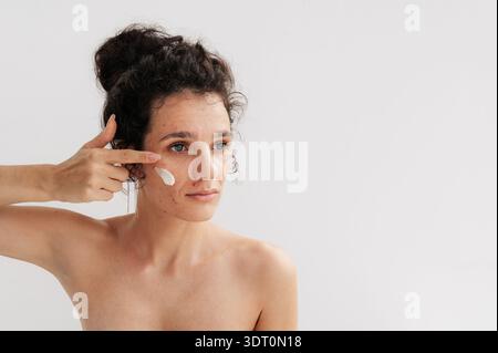 Eine junge Frau mit Akne trägt eine Hautpflegecreme auf ihr Gesicht auf. Stockfoto