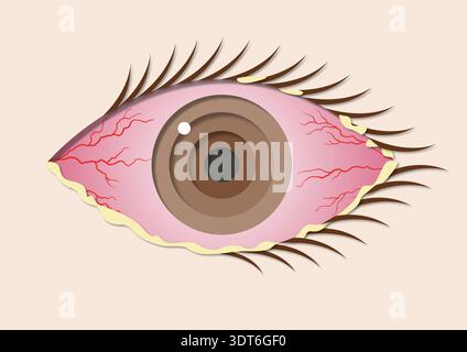 Illustration der bakteriellen Konjunktivitis. Allgemein als rosafarbenes Auge bezeichnet, ist dies eine Entzündung der klaren Membran, die den weißen Teil des Auges bedeckt. Sie führt zu roten, juckenden und geschwollenen Augen, oft begleitet von dickem Eiter, der dazu führen kann, dass die Augenlider aneinander haften. Dieser Zustand verschwindet in der Regel innerhalb von 1 bis 2 Wochen. Antibiotische Augentropfen oder Salben werden häufig verwendet, um die Dauer der Symptome zu verkürzen. Stockfoto