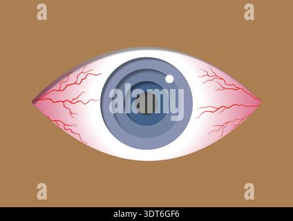 Illustration der Konjunktivitis. Allgemein als rosafarbenes Auge bezeichnet, bei einer Entzündung der klaren Membran, die den weißen Teil des Auges bedeckt. Sie kann durch virale oder bakterielle Infektionen, Allergien oder Reizmittel verursacht werden. Symptome sind rote, juckende und brennende Augen, oft begleitet von übermäßigem Tränen und klebrigem Ausfluss. Das Rosa Auge verschwindet normalerweise innerhalb von ein bis zwei Wochen. Die Behandlung konzentriert sich auf Methoden wie Kältekompressionen, künstliche Tränen und bei bakteriellen Infektionen Antibiotika. Stockfoto