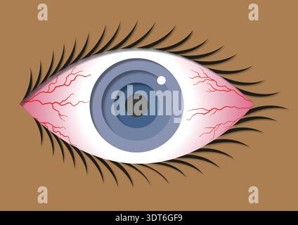 Illustration der Konjunktivitis. Allgemein als rosafarbenes Auge bezeichnet, bei einer Entzündung der klaren Membran, die den weißen Teil des Auges bedeckt. Sie kann durch virale oder bakterielle Infektionen, Allergien oder Reizmittel verursacht werden. Symptome sind rote, juckende und brennende Augen, oft begleitet von übermäßigem Tränen und klebrigem Ausfluss. Das Rosa Auge verschwindet normalerweise innerhalb von ein bis zwei Wochen. Die Behandlung konzentriert sich auf Methoden wie Kältekompressionen, künstliche Tränen und bei bakteriellen Infektionen Antibiotika. Stockfoto