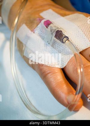 Platzierung einer intravenösen Durchstechflasche (periphere Venenkatheterisierung), Son Llatzer Hospital, Mallorca, Balearen, Spanien. Stockfoto