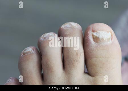 Der Fuß eines Mannes, eine Nahaufnahme eines Fußes mit kranken Nägeln. Ein von Pilz beeinflußter Zehennagel. Stockfoto