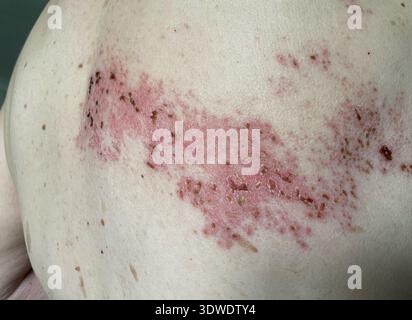 Gürtelrose (Herpes zoster) Hautausschlag auf dem Rücken eines 70-jährigen Mannes. Dies ist das Endstadium des Hautausschlags, wenn die Blasen zu Schorf geworden sind. Stockfoto