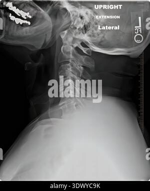 Laterale Röntgenaufnahme der menschlichen Halswirbelsäule, die die Halswirbel in aufrechter Ausstreckungsposition zeigt, Anatomie, Knochenstruktur und medikamentöse Darstellung Stockfoto
