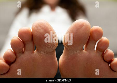 Vorderansicht mit Fußsohlen und verhärteter Haut an den Zehen. Medizinische Weitwinkel-Fotografie symbolisiert Fußgesundheit Probleme und trockene Haut. Stockfoto