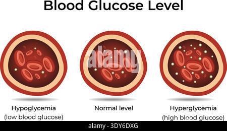 Blutzuckerspiegel Hypoglykämie Normale Hypoglykämie Design-Vektor-Illustration. Stock Vektor