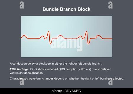 Abbildung eines Elektrokardiogramms (EKG) bei einem Schenkelblock (BBB). Dies zeigt eine charakteristische QRS-Erweiterung und ein verändertes ventrikuläres Überleitungsmuster. Stockfoto