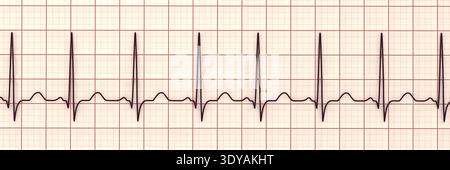 Abbildung eines Elektrokardiogramms (EKG) mit Sinustachykardie. Das EKG zeigt einen Sinusrhythmus mit verkürzten RR-Intervallen und erhöhter Herzfrequenz. Stockfoto