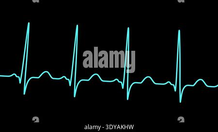 Abbildung eines Elektrokardiogramms (EKG) mit Sinustachykardie. Das EKG zeigt einen Sinusrhythmus mit verkürzten RR-Intervallen und erhöhter Herzfrequenz. Stockfoto