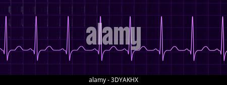Abbildung eines Elektrokardiogramms (EKG) mit Sinustachykardie. Das EKG zeigt einen Sinusrhythmus mit verkürzten RR-Intervallen und erhöhter Herzfrequenz. Stockfoto