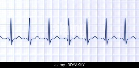 Abbildung eines Elektrokardiogramms (EKG) mit Sinustachykardie. Das EKG zeigt einen Sinusrhythmus mit verkürzten RR-Intervallen und erhöhter Herzfrequenz. Stockfoto