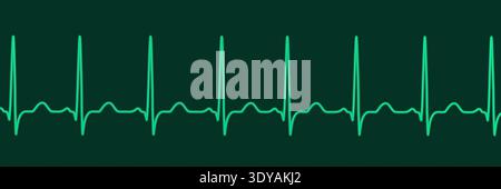 Abbildung eines Elektrokardiogramms (EKG) mit Sinustachykardie. Das EKG zeigt einen Sinusrhythmus mit verkürzten RR-Intervallen und erhöhter Herzfrequenz. Stockfoto