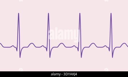 Abbildung eines Elektrokardiogramms (EKG) mit Sinustachykardie. Das EKG zeigt einen Sinusrhythmus mit verkürzten RR-Intervallen und erhöhter Herzfrequenz. Stockfoto