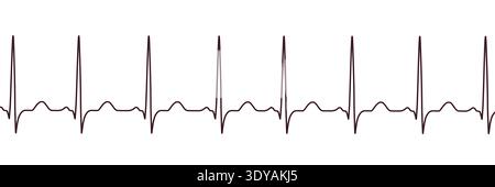 Abbildung eines Elektrokardiogramms (EKG) mit Sinustachykardie. Das EKG zeigt einen Sinusrhythmus mit verkürzten RR-Intervallen und erhöhter Herzfrequenz. Stockfoto