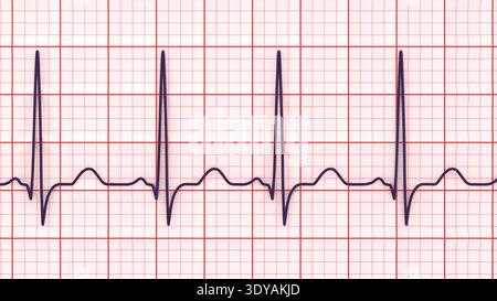 Abbildung eines Elektrokardiogramms (EKG) mit Sinustachykardie. Das EKG zeigt einen Sinusrhythmus mit verkürzten RR-Intervallen und erhöhter Herzfrequenz. Stockfoto
