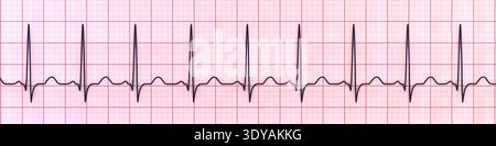 Abbildung eines Elektrokardiogramms (EKG) mit Sinustachykardie. Das EKG zeigt einen Sinusrhythmus mit verkürzten RR-Intervallen und erhöhter Herzfrequenz. Stockfoto