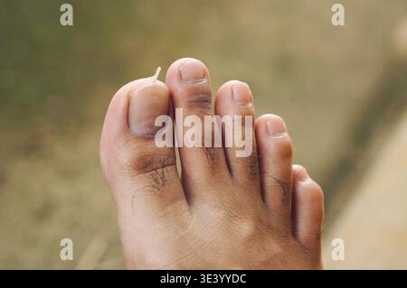 Die Haut am großen Zeh hat sich aufgrund von Trockenheit abgelöst. Stockfoto