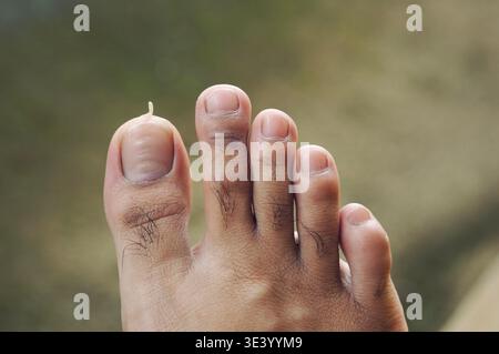 Die Haut am großen Zeh hat sich aufgrund von Trockenheit abgelöst. Stockfoto