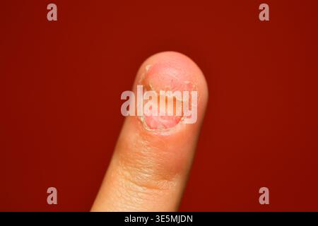 Beschädigter Nagel zeigt Gesundheitsproblem. Zehennagelpilz. Ein Podologe untersucht Zehennägel, die von einer Pilzinfektion betroffen sind. Onycholyse der Nägel. Zehennagel Stockfoto
