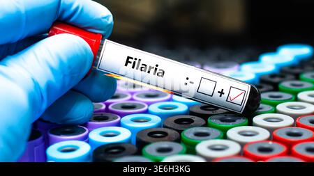 Blutprobe des Patienten-positiven Filarienergebnisses. Stockfoto