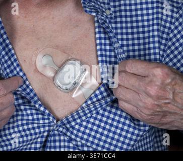 Kleiner selbstklebender Herz-EKG-Langzeit-Herzfrequenzsensor auf männlicher Brust Stockfoto