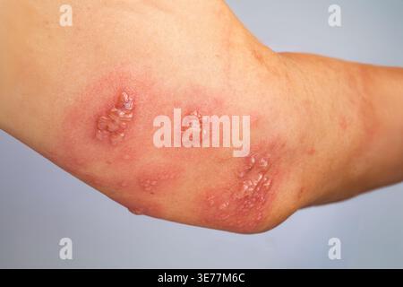 Gürtelrose, Zoster oder Herpes zoster Symptome am Arm. Stockfoto