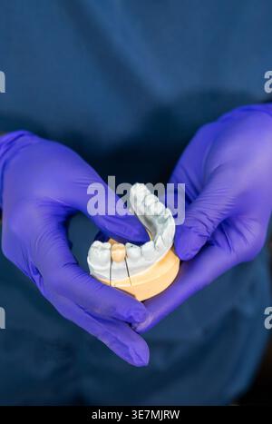 Hände einer Zahnarztpraxis in Latexhandschuhen mit keramischem Kronenmodell Stockfoto