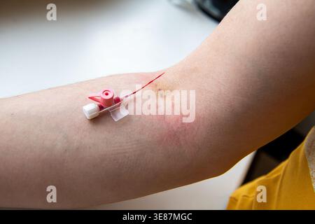 Nahaufnahme eines Personenarms mit Punktionsstelle und Einbuchtung am Körper, an dem gerade ein IV-Katheter entfernt wurde. Hochwertige Fotos Stockfoto